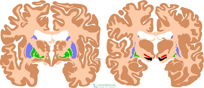 therapy-for-cerebral-palsy-cp-treatment