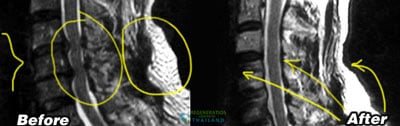 spinal-cord-injury-treatment-stem-cells