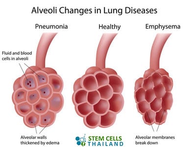 alvioli-regeneration-stem-cells-emphysema-regen
