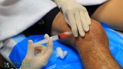 sports-injuries-stemcells-thailand