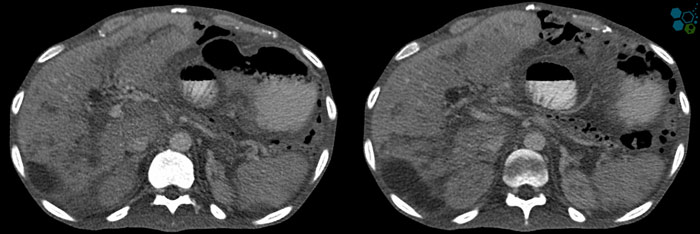 Acute Pancreatitis treatment