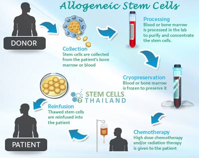 Allogenic Stem Cell Transplants