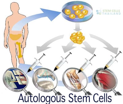 autologous-bone-marrow-illiac-crest-extractions