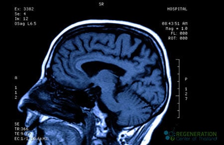 traumatic-brain-injury-treatment-stemcells-bangkok