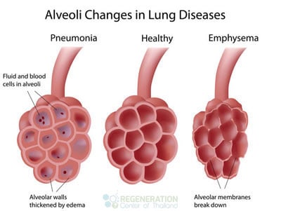 alvioli-restoration-stem-cells-Idiopathic-Pulmonary-Fibrosis-stem-cells-regen