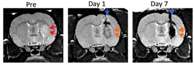 before-after-stemcells-stroke-brain