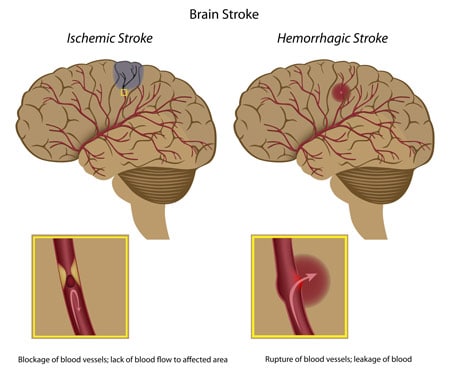 ischemic-stroke-vs-hemorrhagic-stroke