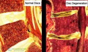 stem-cell-treatment-herniated-lumbar-disc-300