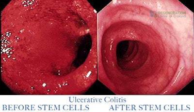 Ulcerative-colitis-ibd-before-after-stem-cells