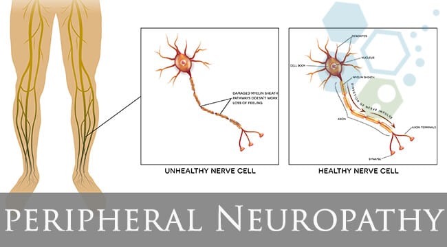 new-peripheral-neuropathy-treatments