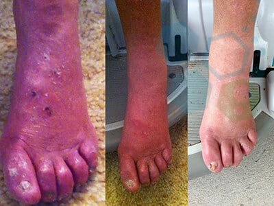 reverse-diabetic-neuropathy