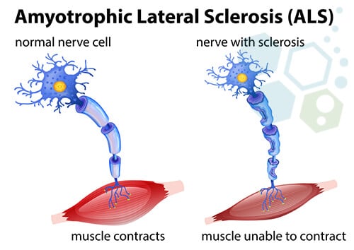 Lou Gehrig's disease