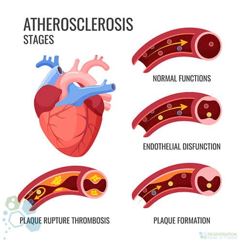 clogged-artery-coronary atherosclerosis