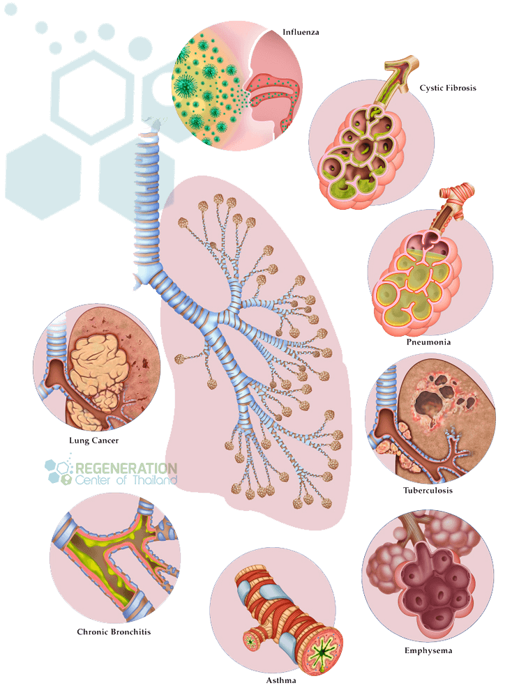 lung-diseases