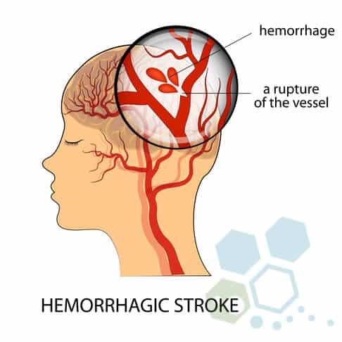 hemorrhagic-stroke-treatment-alteplase