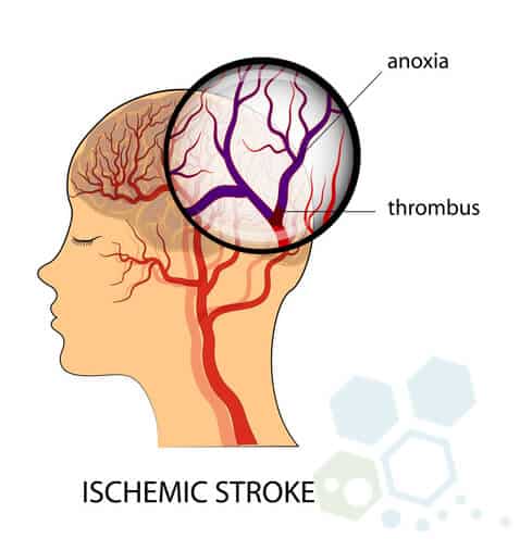 stem-cell-treatment-ischemic-stroke