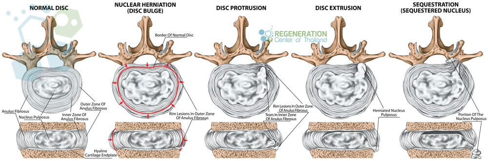 stem-cells-herniated-discs