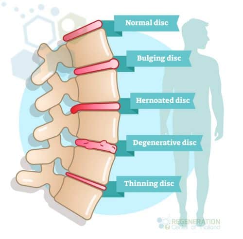 stem-cells-spinal-stenosis