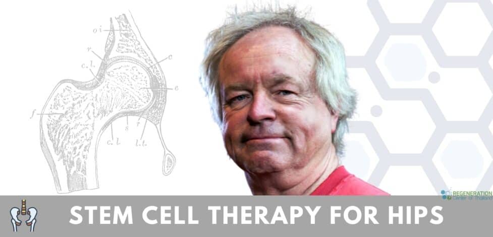 stem cell treatment for hip
