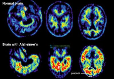 Alzheimers-dementia-comparison-normal-brain-stemcells