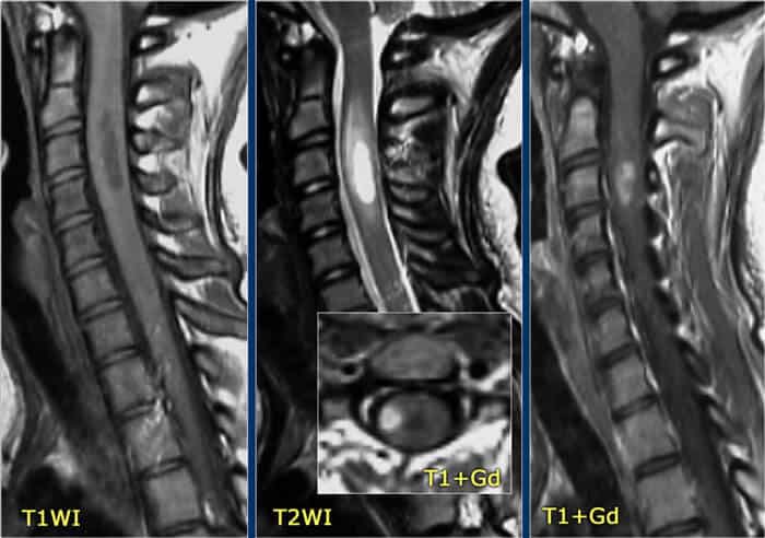 After-stemcell-treatment-Transverse-myelitis