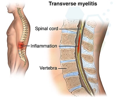 Transverse-myelitis-disease