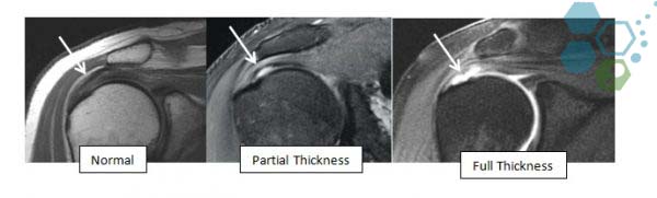 rotator-cuff-after-treatment-stem-cell-therapy