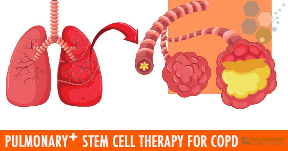 Stem-Cell-Treatment-COPD-2022